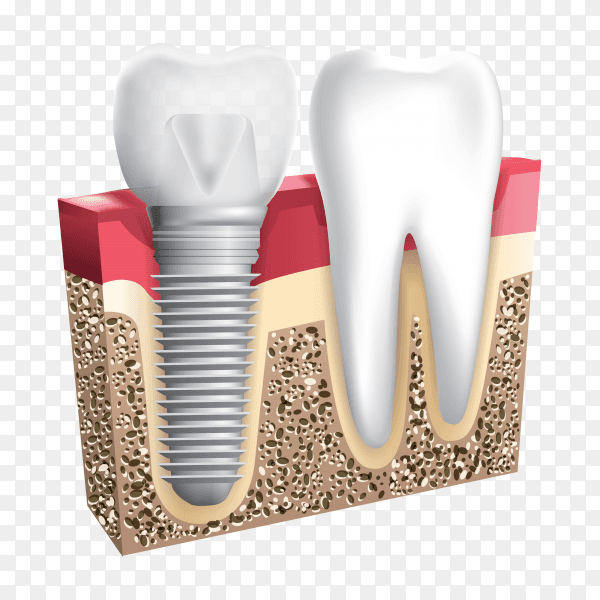 Tooth set. Human realistic teeth and Dental implant on transparent background PNG