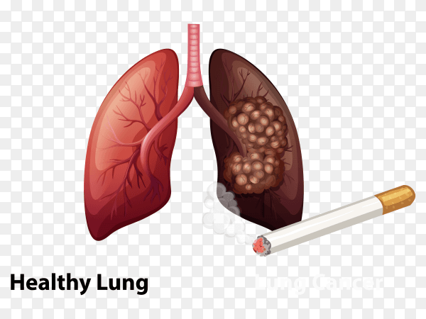 Healthy lung and cancer lung injured vector PNG