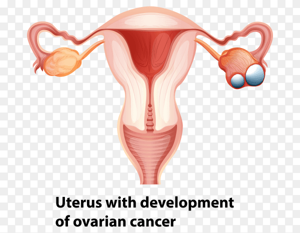 Uterus with development of ovarian cancer on transparent PNG