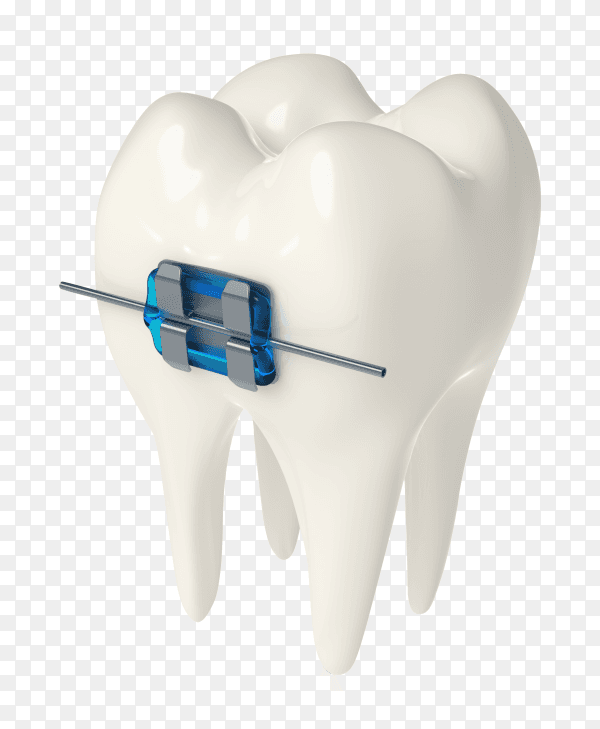 3D render tooth with ceramic metal braces gums on transparent background PNG