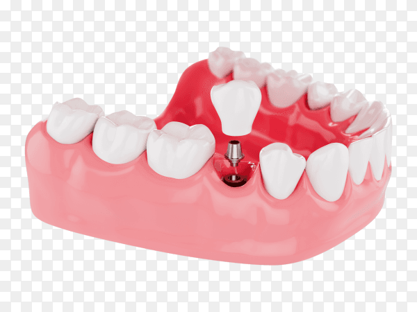 Close up process implants teeth health care on transparent background PNG