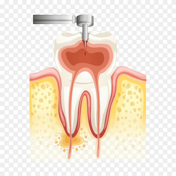 Dental root canal on transparent background PNG