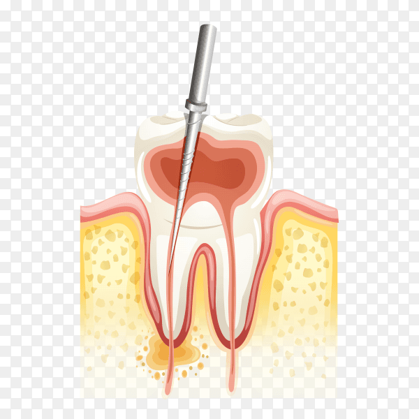 Root canal process on transparent background PNG