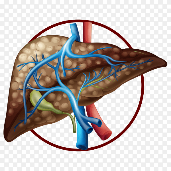 Illustration of Liver cirrhosis on transparent background PNG
